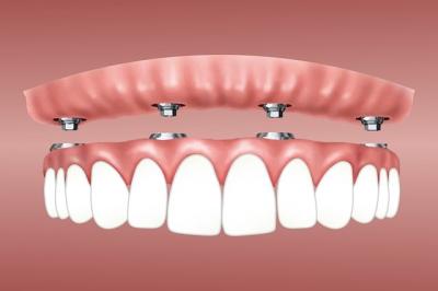 implant dentaire - dentiste chelles